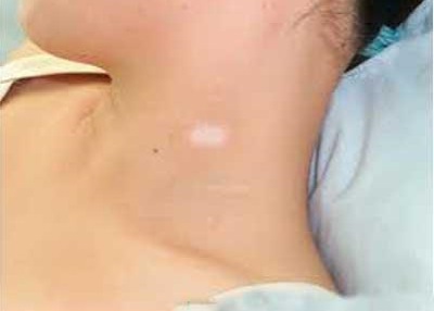 医用星空体育解析缺少锌元素会引起白癜风吗-山东国康